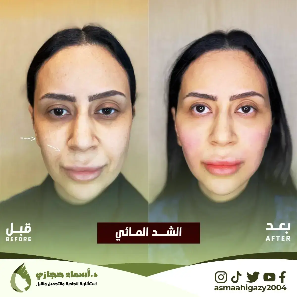 الشد المائي