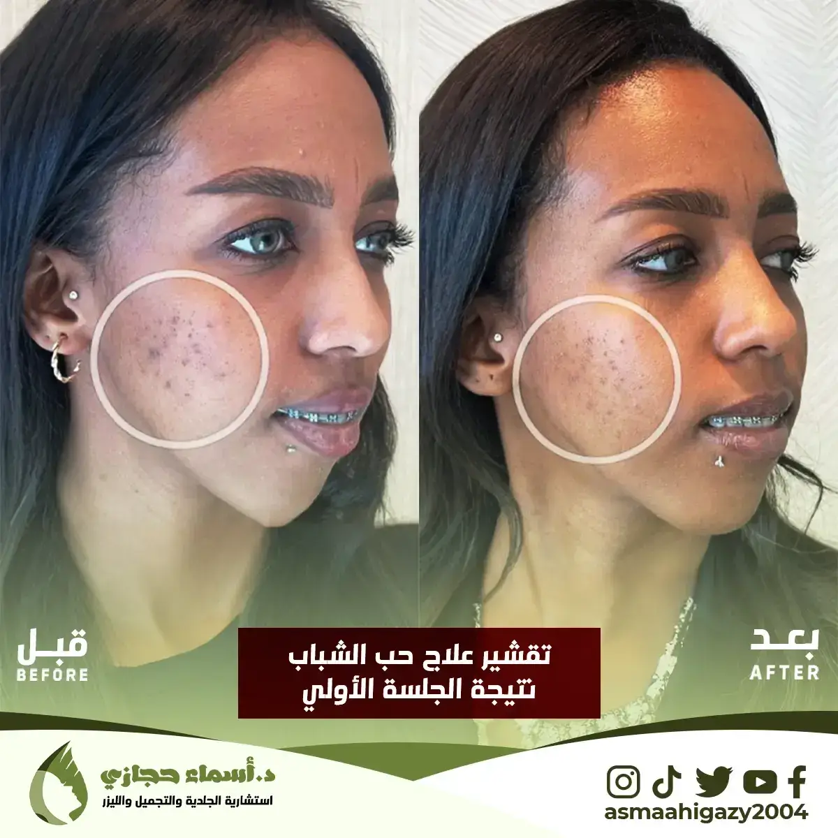 Jo-25-Apr-23-B&Amp;A-تقشير-1 Copy