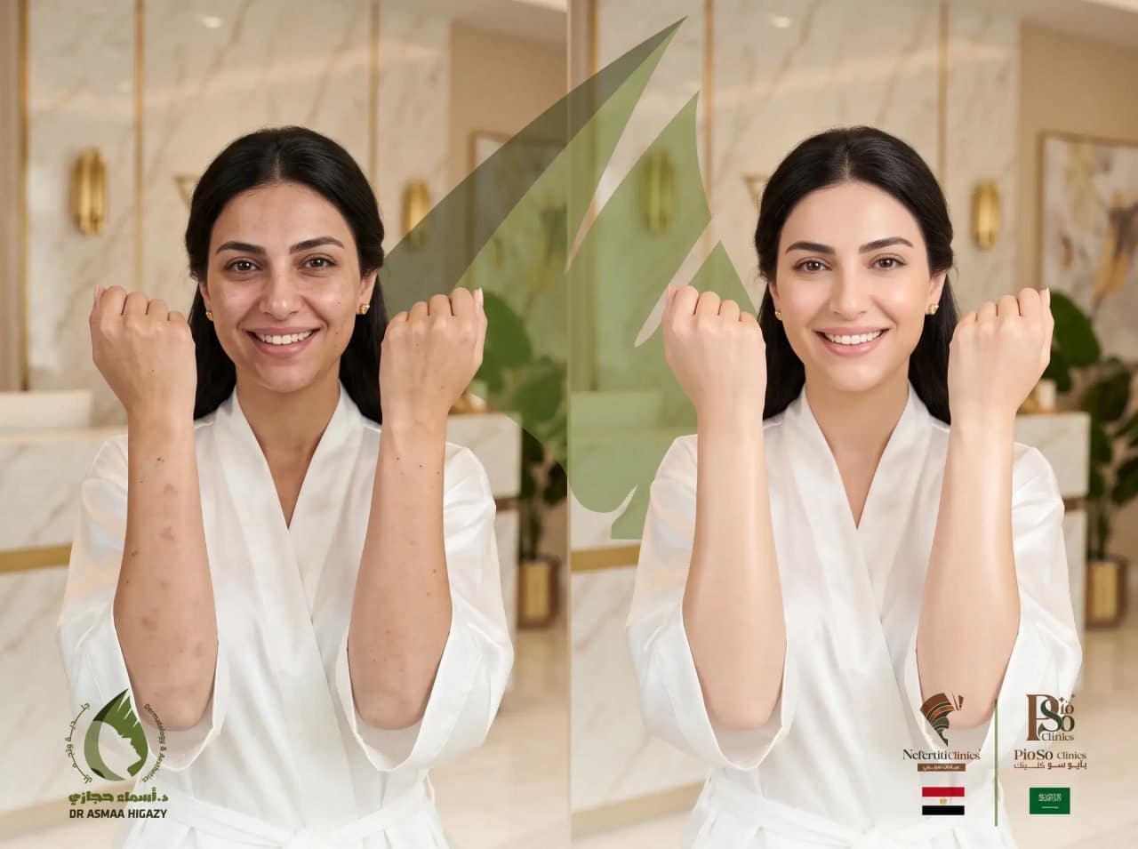 تجربتي مع التقشير البارد للبكيني