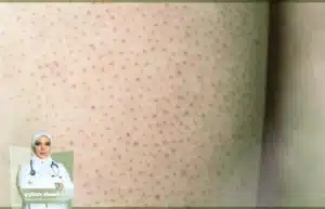 علاج جلد الوزة