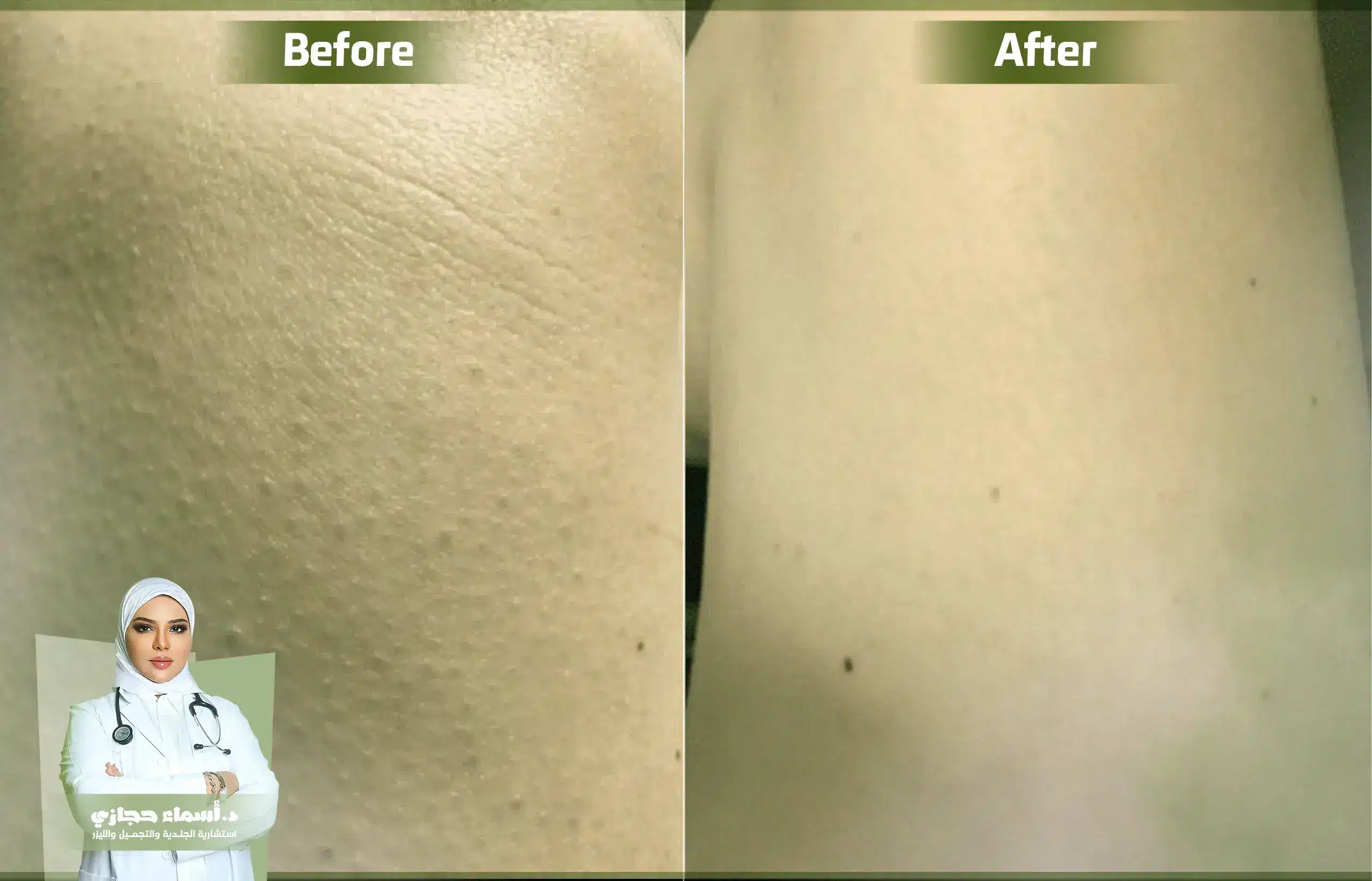 علاج جلد الوزة