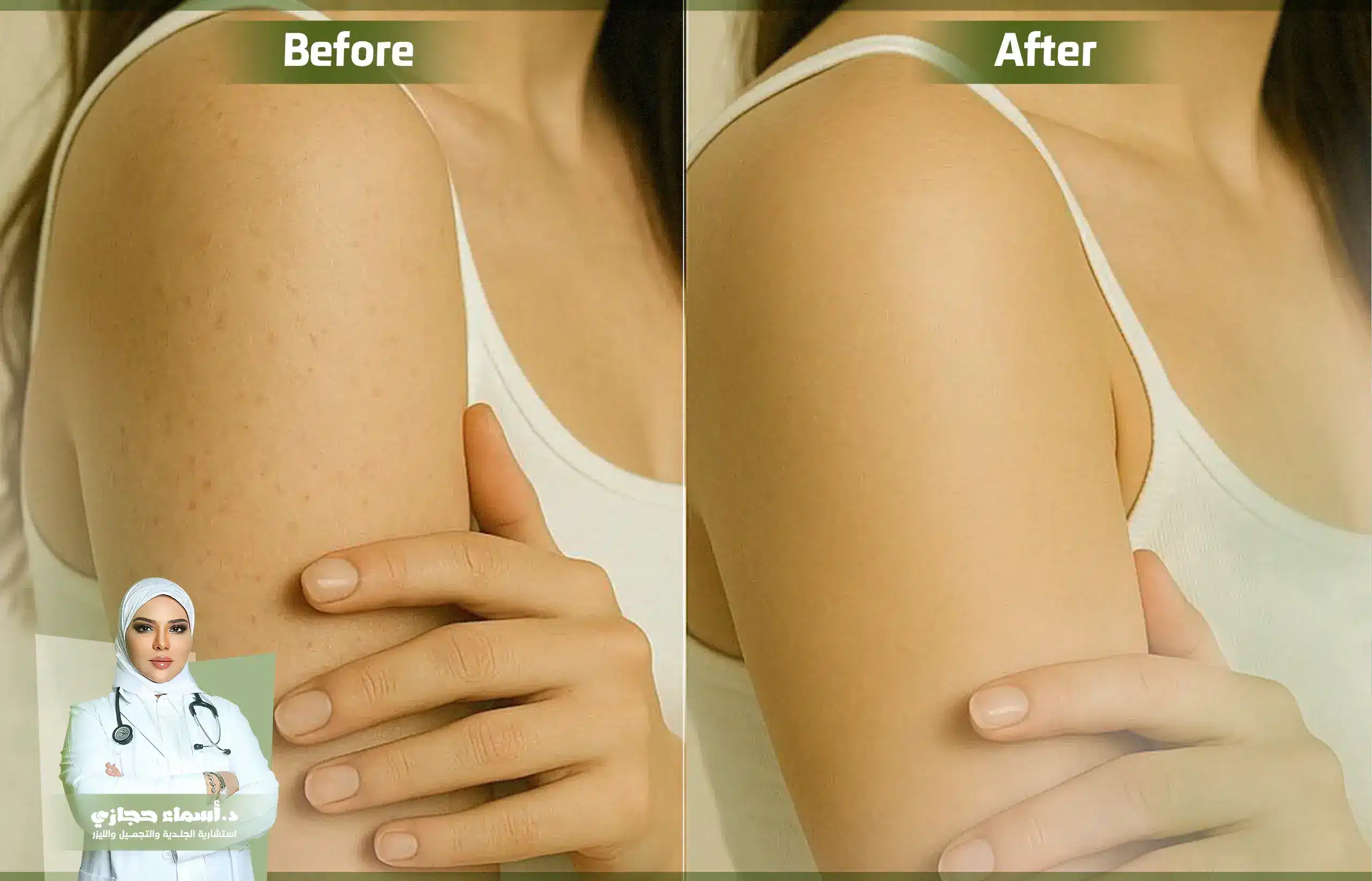 علاج جلد الوزة