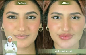 أفضل دكتورة فيلر شفايف في جدة