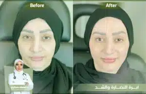 إبرة الدورثي