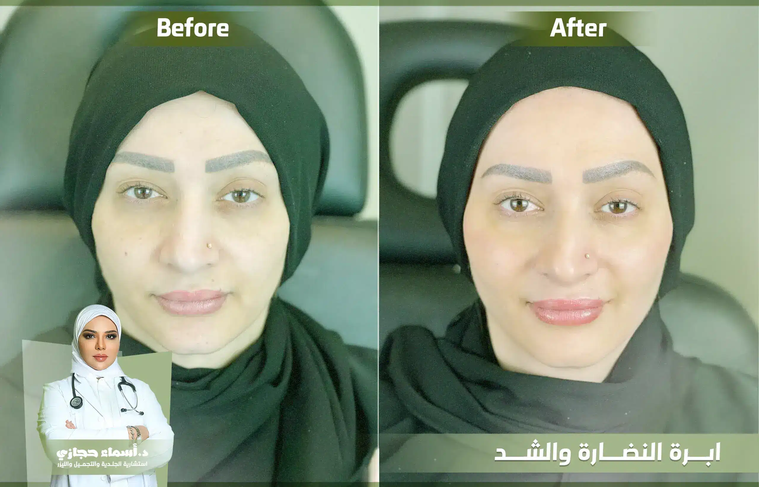 إبرة الدورثي