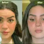 أفضل دكتور حقن بوتكس في جدة