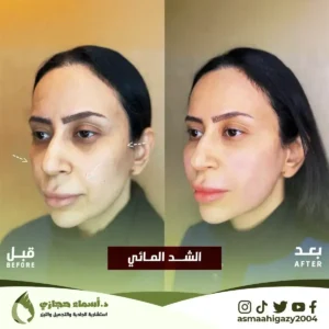 الشد المائي للوجه | الموقع الالكتروني للدكتورة اسماء حجازي