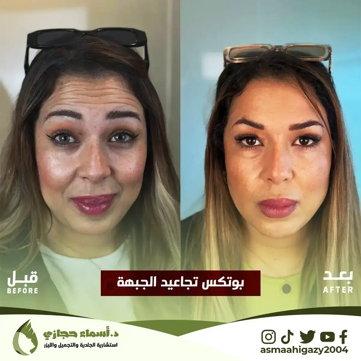 بوتكس التجاعيد قبل وبعد دكنورة اسماء حجازي | الموقع الالكتروني للدكتورة اسماء حجازي بوتكس التجاعيد قبل وبعد دكنورة اسماء حجازي
