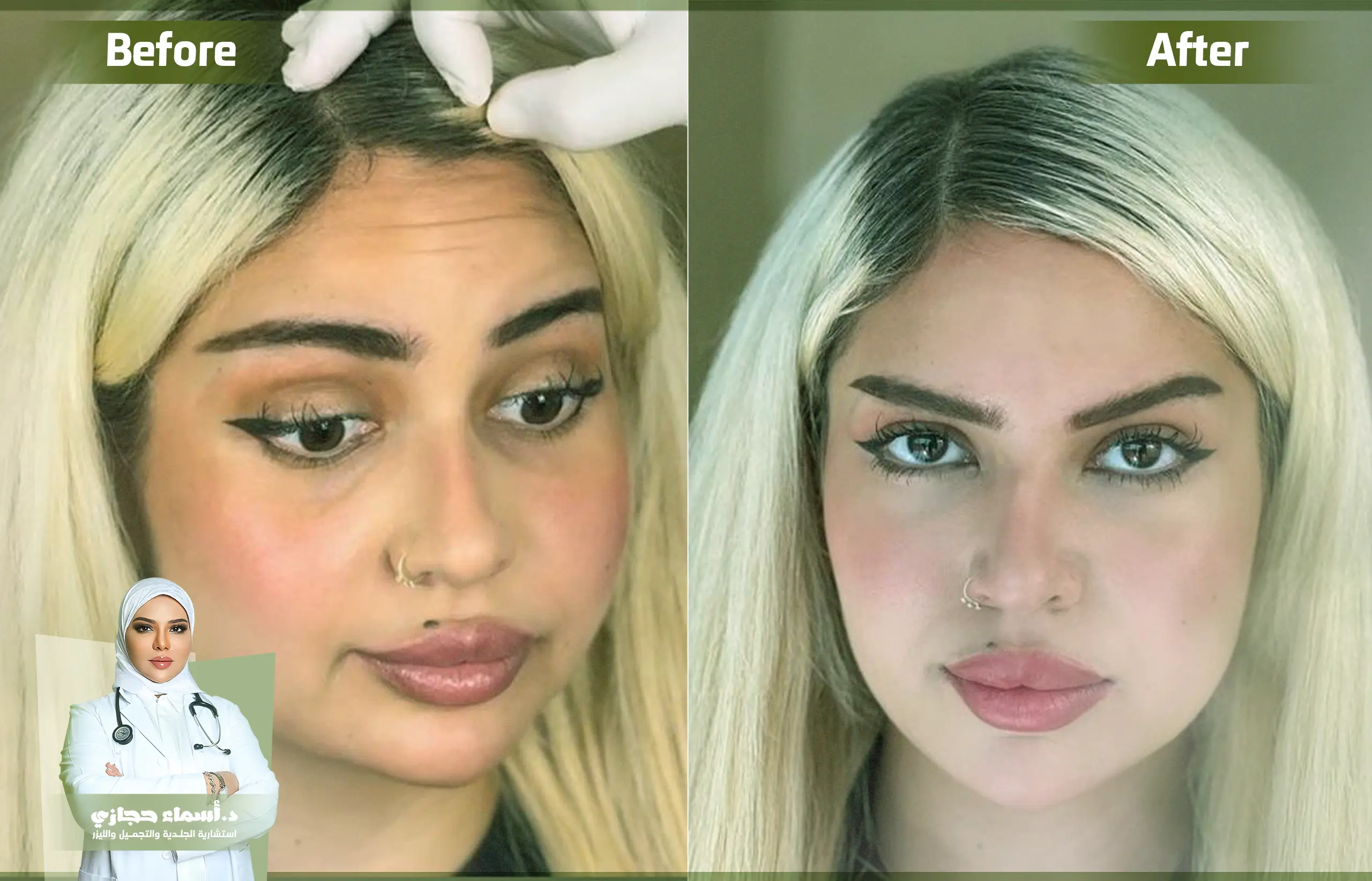 حقن البوتكس قبل وبعد مع دكتورة أسماء حجازي | الموقع الالكتروني للدكتورة اسماء حجازي حقن البوتكس قبل وبعد مع دكتورة أسماء حجازي | الموقع الالكتروني للدكتورة اسماء حجازي