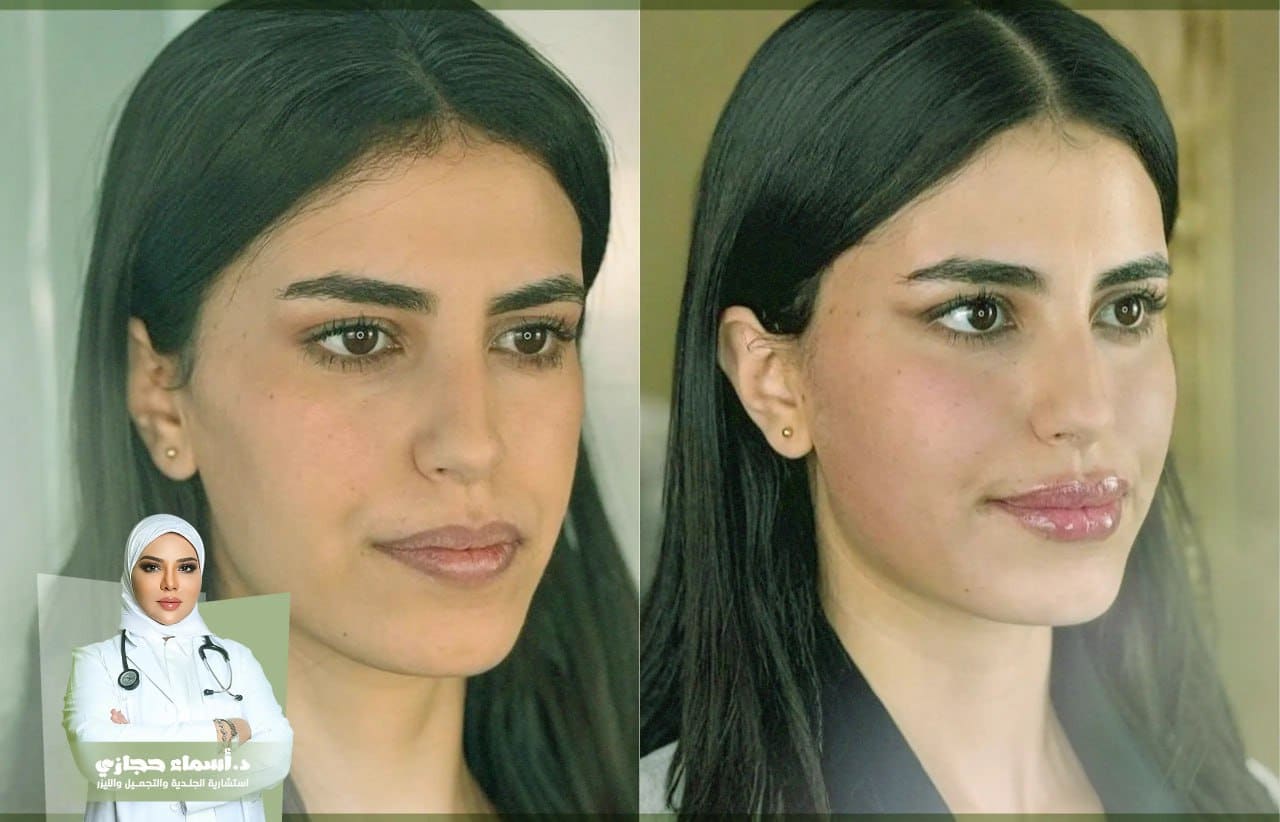 جلسة فيلر الوجه