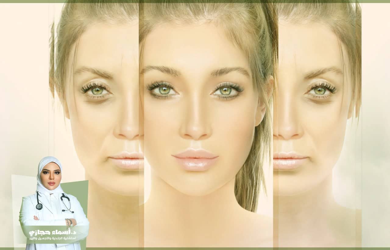 الفيلر للوجه قبل وبعد