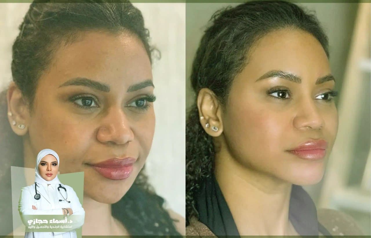 نتائج حقن الفيلر للوجه