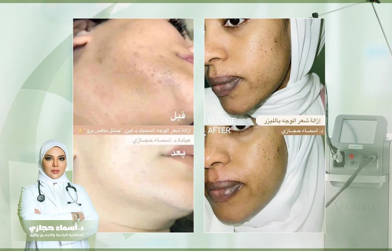 هل ليزر إزالة الشعر آمن؟ مع الدكتورة اسماء حجازي.Jpg 1 | الموقع الالكتروني للدكتورة اسماء حجازي ازالة الشعر بالليزر قبل وبعد